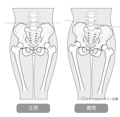 骨盤画像